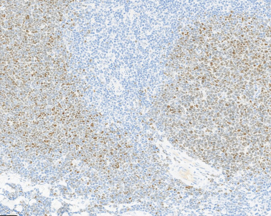 Marquage immunohistochimique anti-SOX-11 — Dartmon