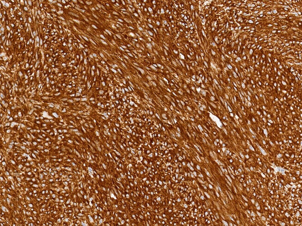 Marquage immunohistochimique anti-c-KIT/CD117 — Dartmon
