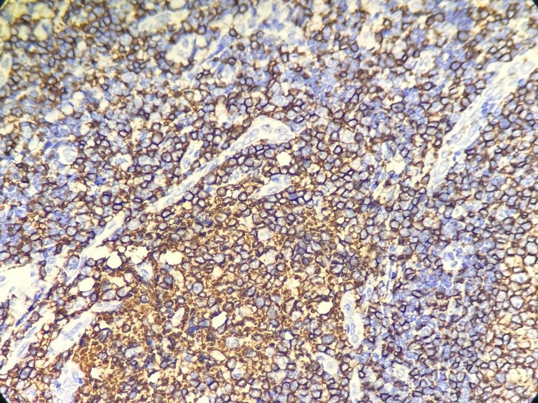Marquage immunohistochimique anti-CD20 — Dartmon