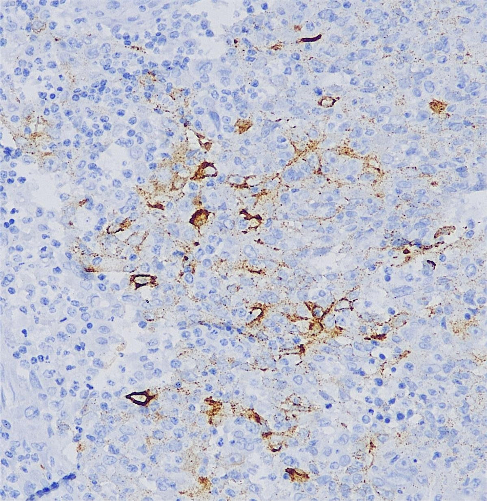 Marquage immunohistochimique anti-EBV / LMP-1 — Dartmon