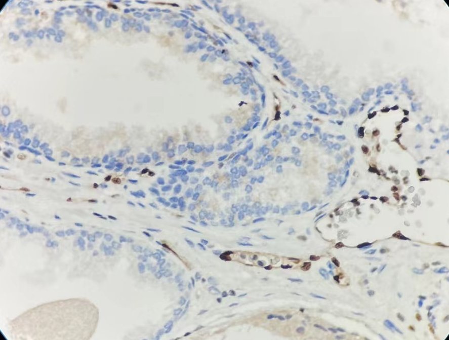 Marquage immunohistochimique anti-ERG — Dartmon