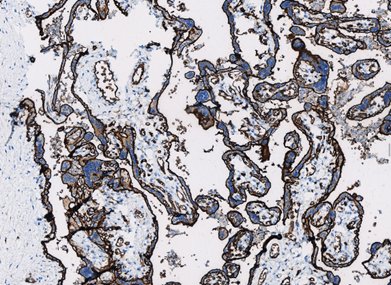 Marquage immunohistochimique anti-GLUT-1 — Dartmon