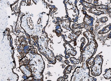 Marquage immunohistochimique anti-GLUT-1 — Dartmon