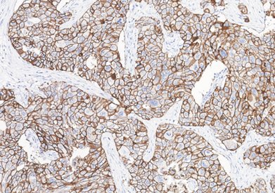 Marquage immunohistochimique anti-HER2 — Dartmon
