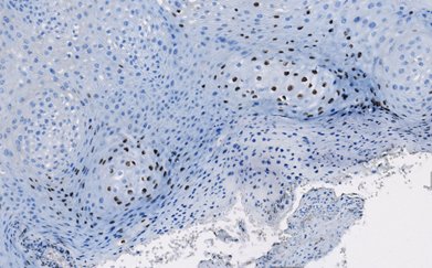 Marquage immunohistochimique anti-HPV16 — Dartmon