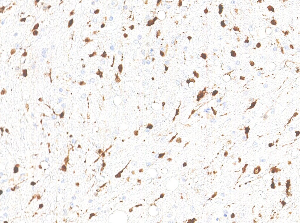 Marquage immunohistochimique anti-IDH1 — Dartmon