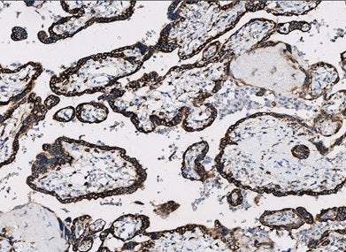 Marquage immunohistochimique anti-IMP3 — Dartmon