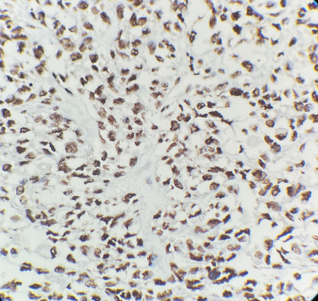 Marquage immunohistochimique anti-INI-1 — Dartmon