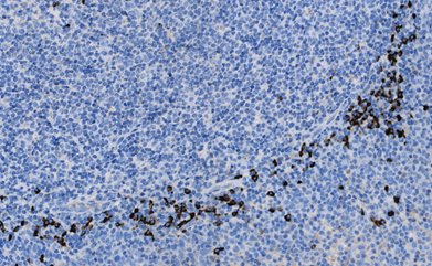 Marquage immunohistochimique anti-Chaîne légère lambda — Dartmon