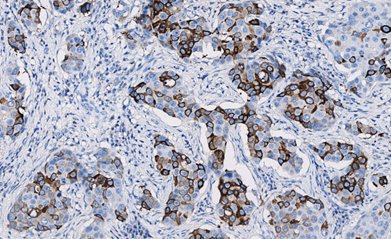 Marquage immunohistochimique anti-Mammaglobine — Dartmon