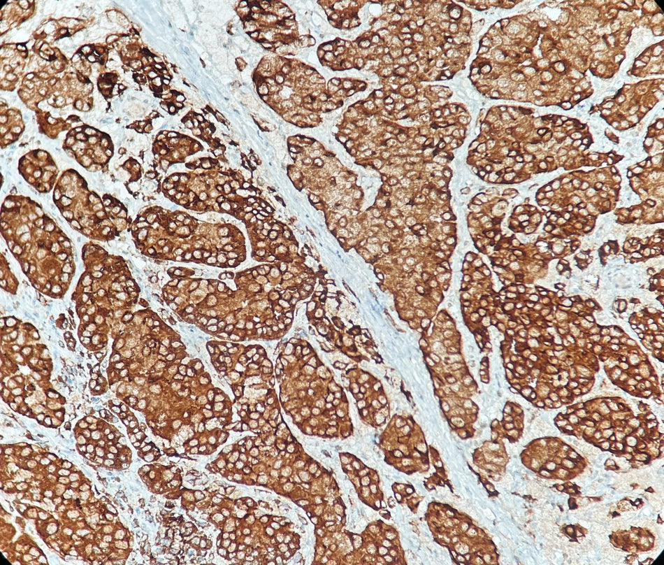 Marquage immunohistochimique anti-HMB45 — Dartmon