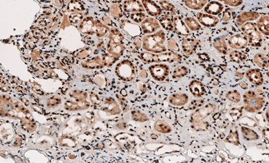 Marquage immunohistochimique anti-MGMT — Dartmon