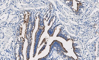 Marquage immunohistochimique anti-MUC-4 — Dartmon