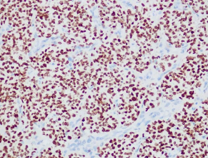 Marquage immunohistochimique anti-NKX2.2 — Dartmon