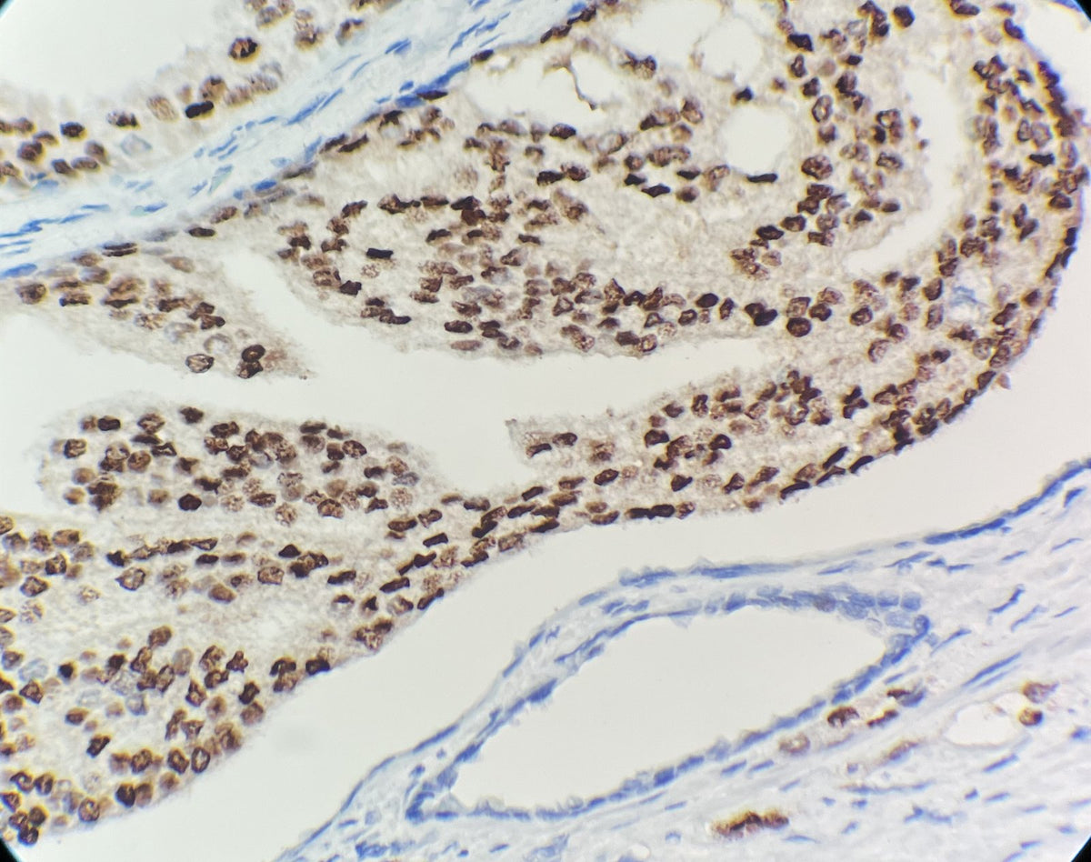 Marquage immunohistochimique anti-NKX3.1 — Dartmon