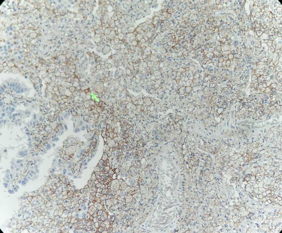 Marquage immunohistochimique anti-PD-L1 — Dartmon