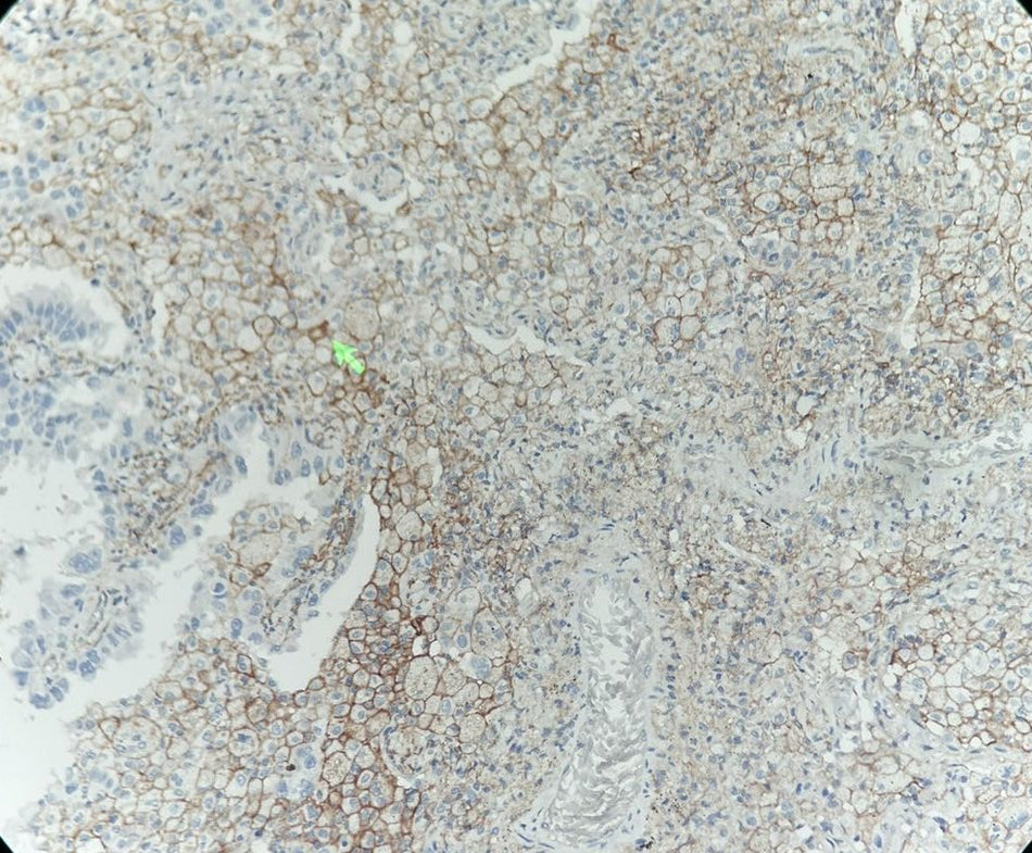 Marquage immunohistochimique anti-PD-L1 — Dartmon