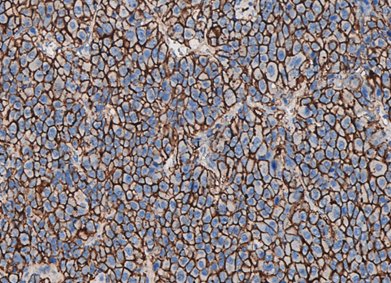 Marquage immunohistochimique anti-P-gp — Dartmon