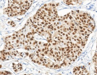 Marquage immunohistochimique anti-PR — Dartmon