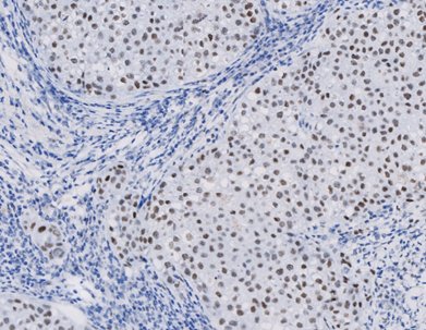 Marquage immunohistochimique anti-Rb — Dartmon