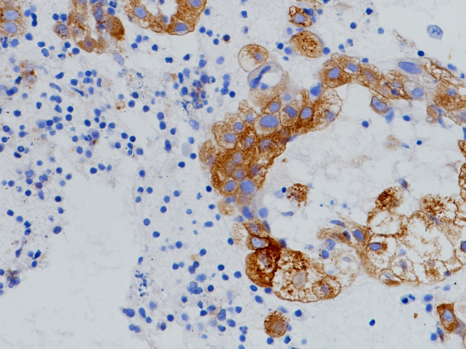 Marquage immunohistochimique anti-ROS1 — Dartmon