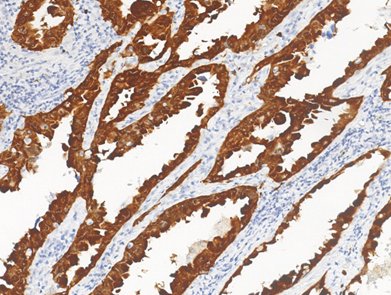 Marquage immunohistochimique anti-S100P — Dartmon