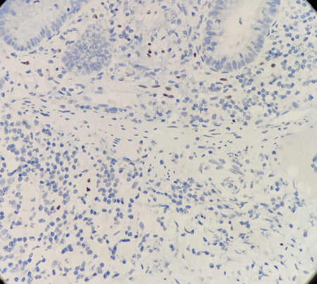 Marquage immunohistochimique anti-SOX-10 — Dartmon