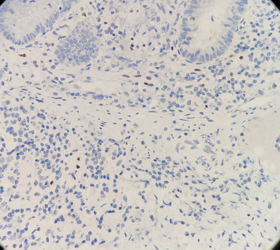 Marquage immunohistochimique anti-SOX-10 — Dartmon