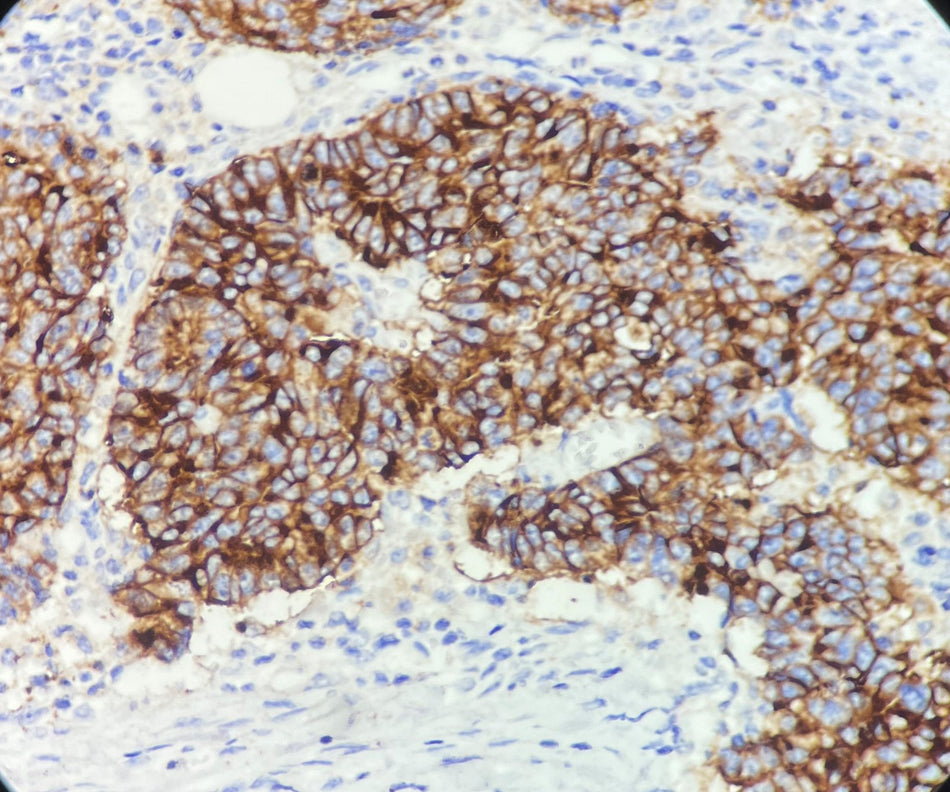 Marquage immunohistochimique anti-CA 19-9 — Dartmon