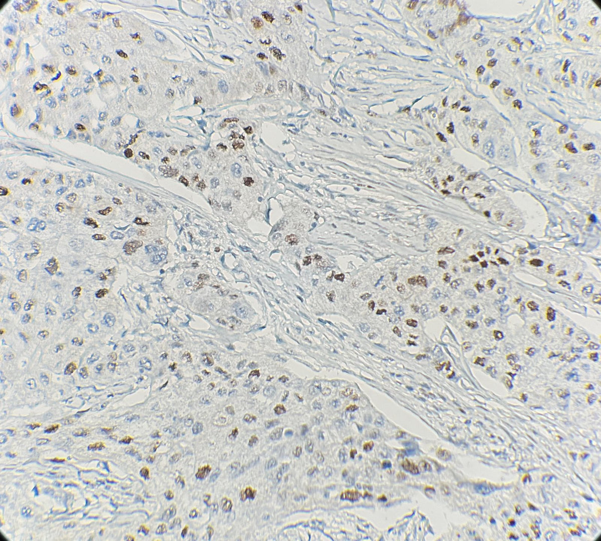 Marquage immunohistochimique anti-Cyclin D1 — Dartmon