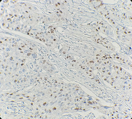Marquage immunohistochimique anti-Cyclin D1 — Dartmon