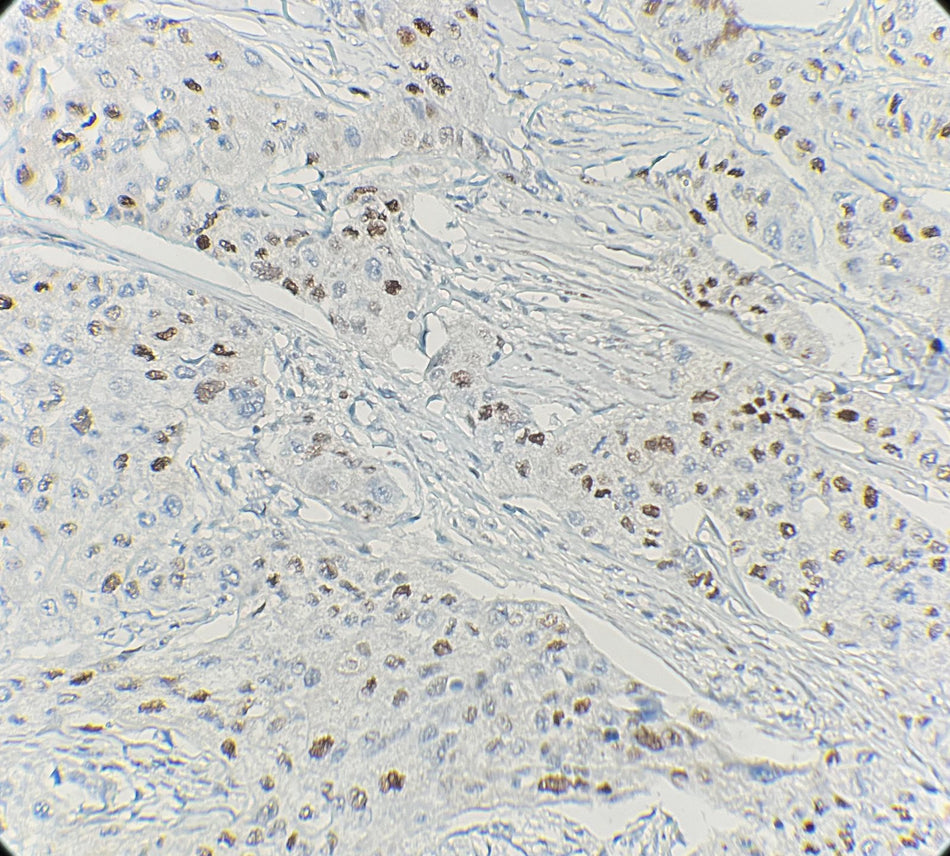Marquage immunohistochimique anti-Cyclin D1 — Dartmon