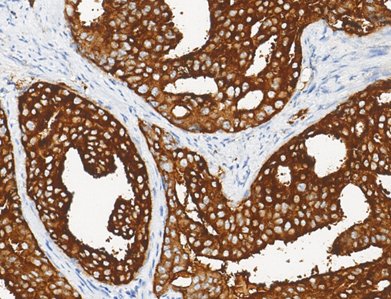 Marquage immunohistochimique anti-PSAP — Dartmon
