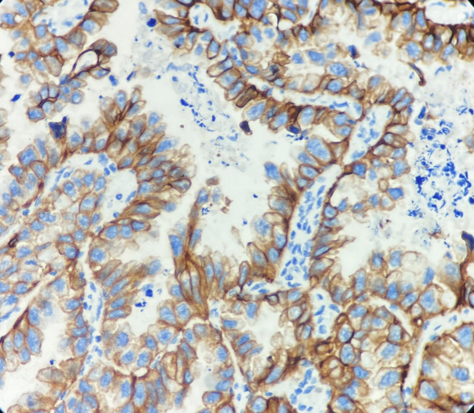 Marquage immunohistochimique anti-CK CAM 5.2 — Dartmon