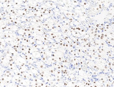 Marquage immunohistochimique anti-Pax-2 — Dartmon