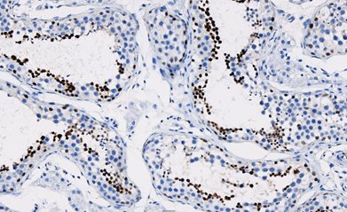 Marquage immunohistochimique anti-NUT — Dartmon