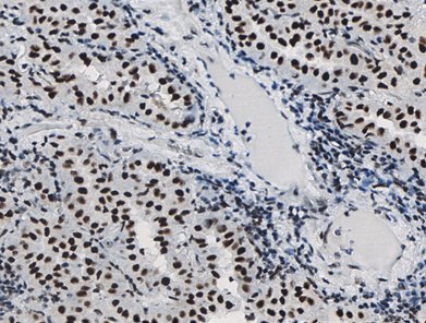 Marquage immunohistochimique anti-SMARCA4 / Brg1 — Dartmon