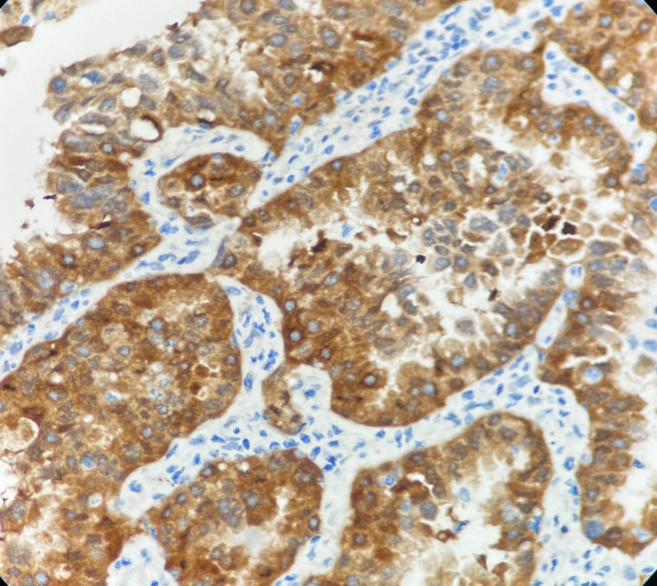 Marquage immunohistochimique anti-CDK4 — Dartmon