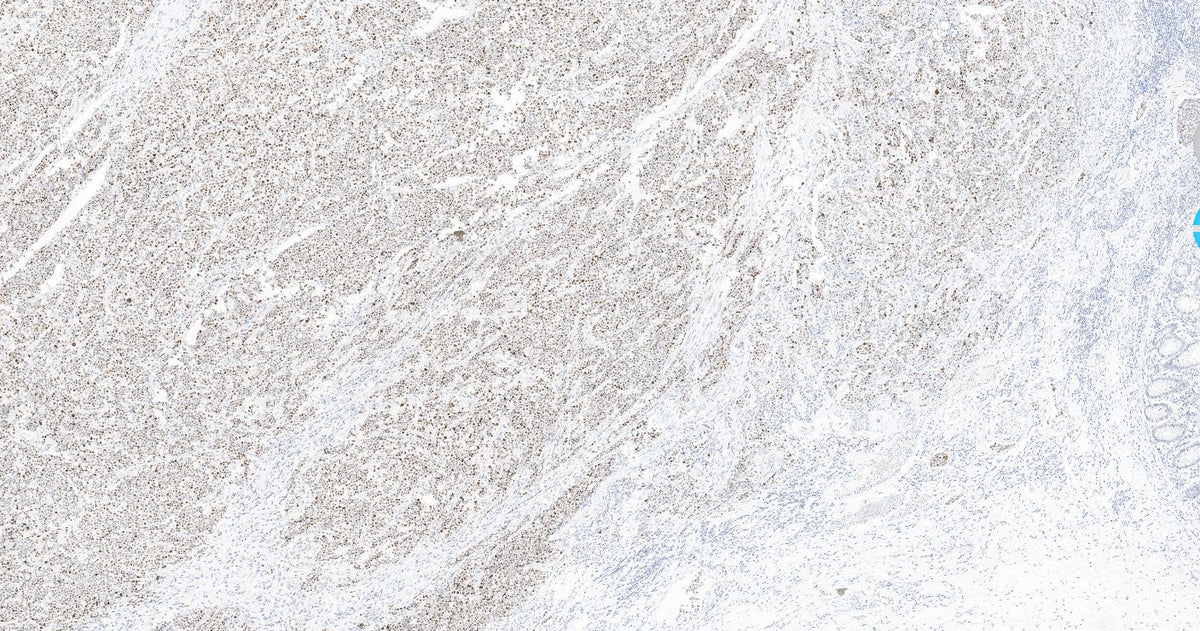 Marquage immunohistochimique anti-p53 — Dartmon