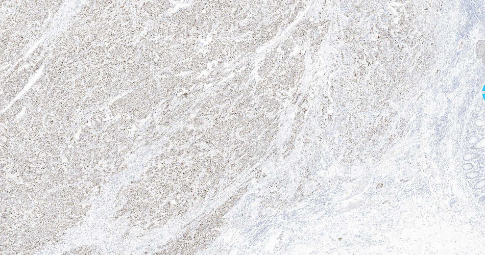 Marquage immunohistochimique anti-p53 — Dartmon