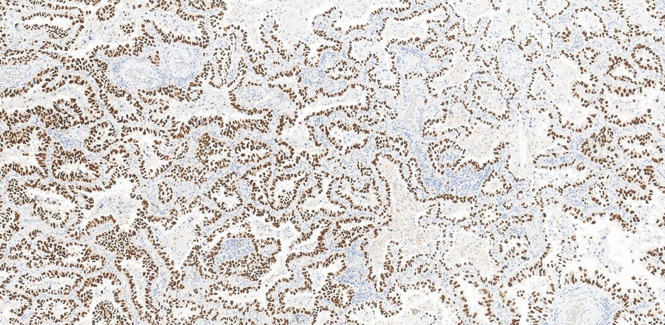 Marquage immunohistochimique anti-TTF-1 — Dartmon