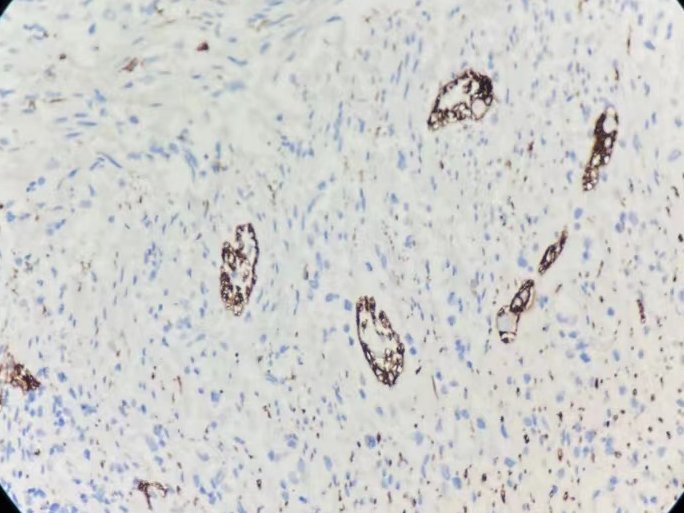 Marquage immunohistochimique anti-CD56 — Dartmon