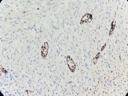 Marquage immunohistochimique anti-CD56 — Dartmon