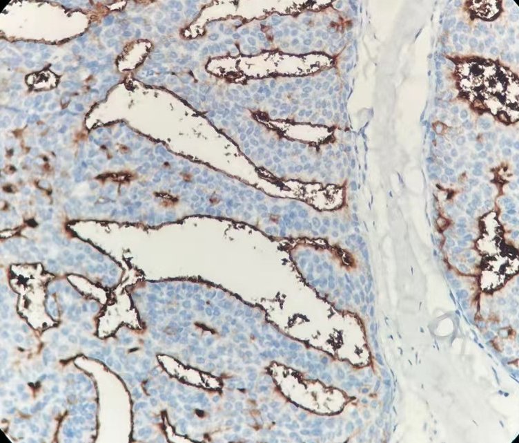 Marquage immunohistochimique anti-EMA — Dartmon