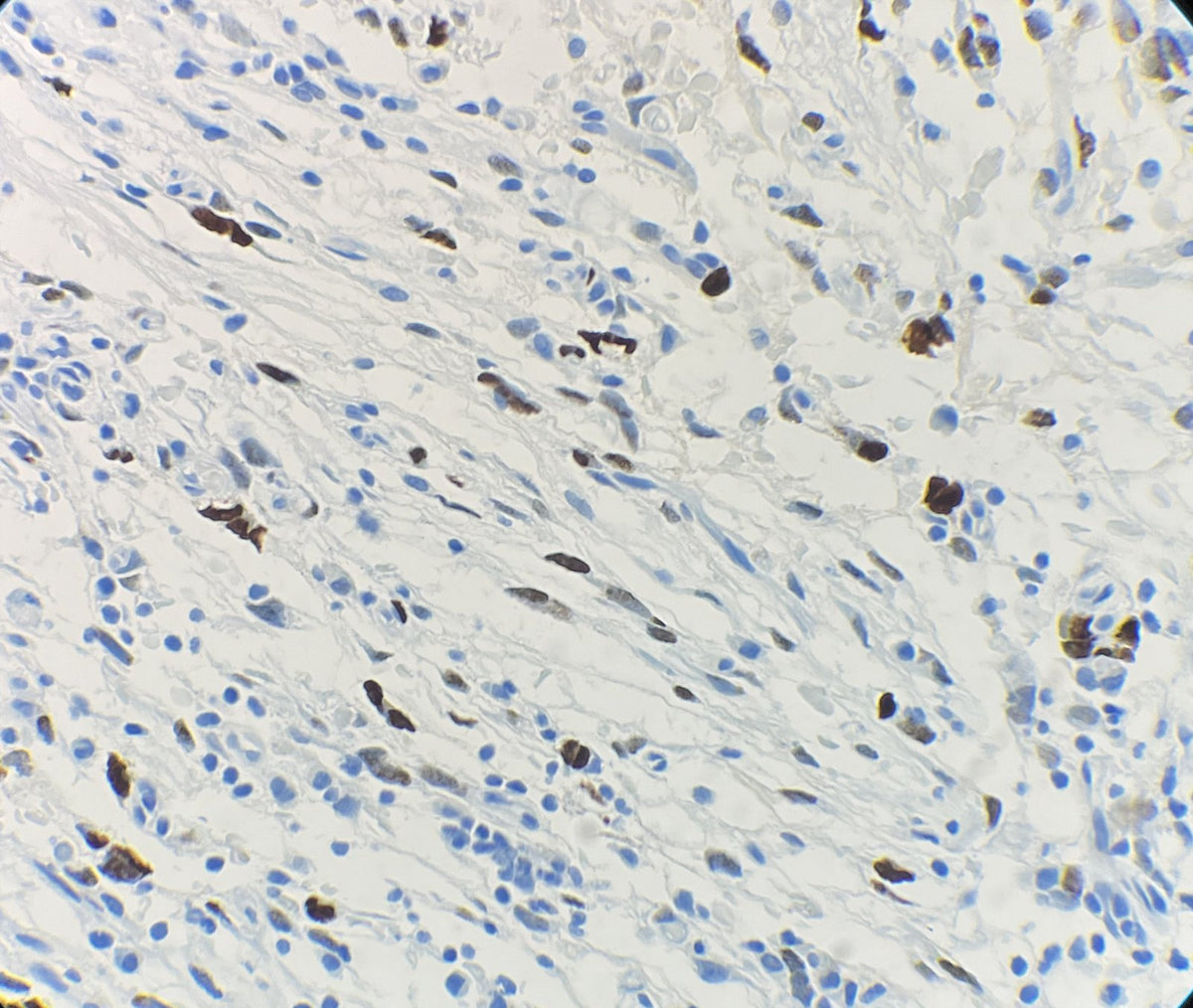 Marquage immunohistochimique anti-MDM2 — Dartmon