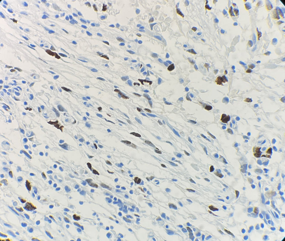 Marquage immunohistochimique anti-MDM2 — Dartmon