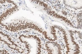 Marquage immunohistochimique anti-MLH1 — Dartmon