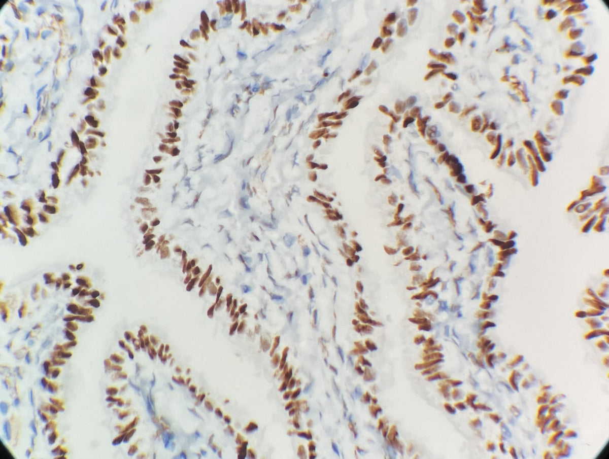 Marquage immunohistochimique anti-WT1 — Dartmon