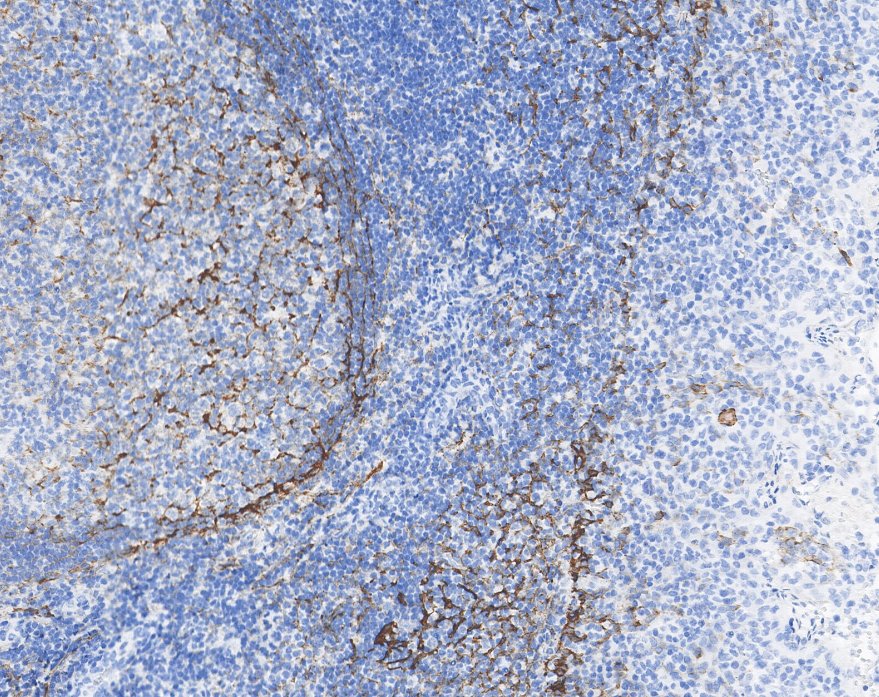 Marquage immunohistochimique anti-D2-40 — Dartmon