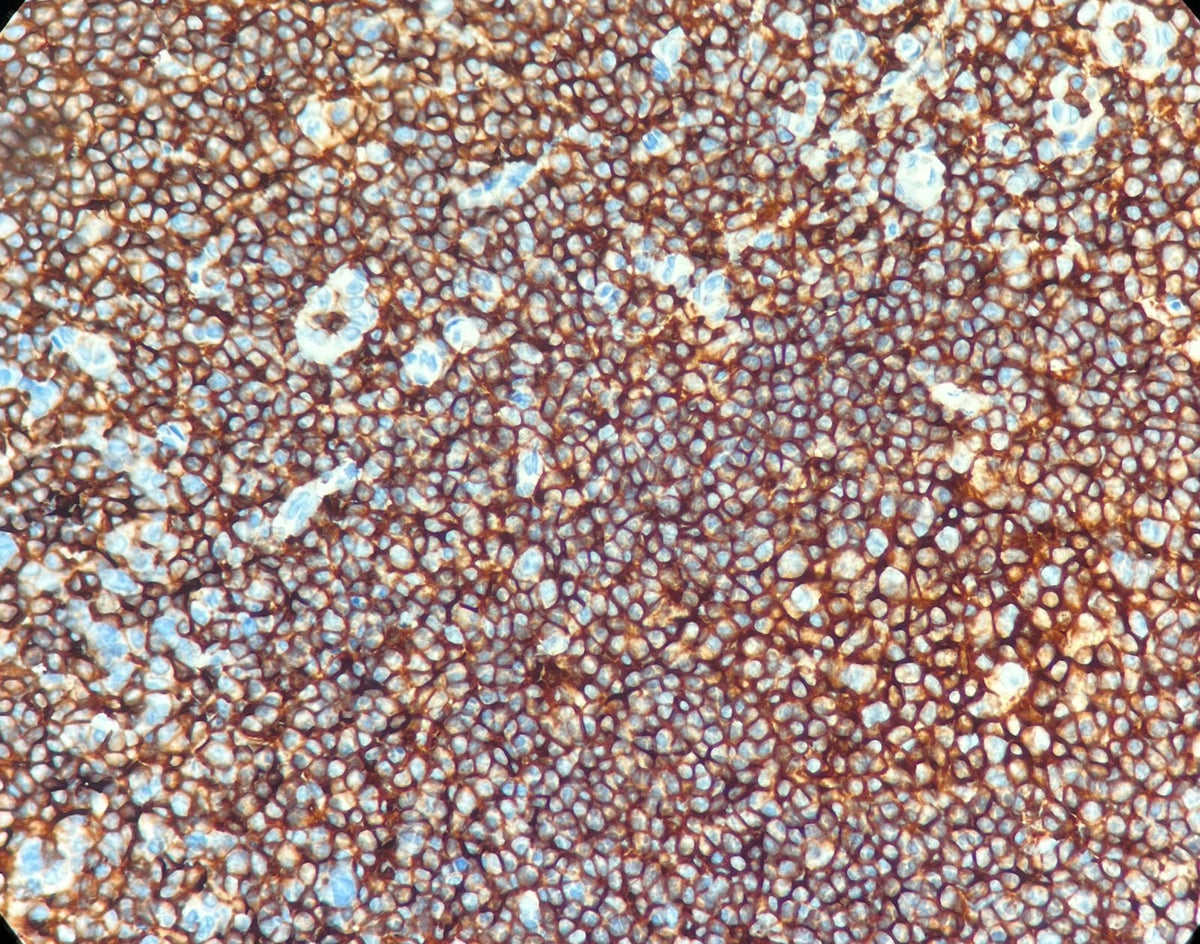 Marquage immunohistochimique anti-CD45 — Dartmon